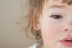 kleines Kind mit Bindehautentzündung am rechten Auge